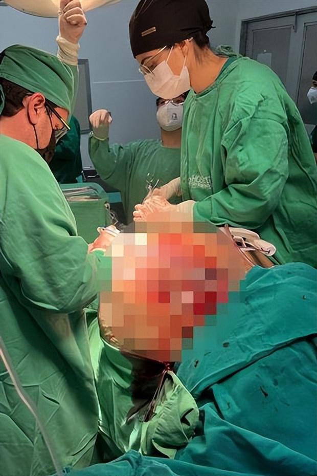 女人在胃切除巨大的七颗石头肿瘤后死亡